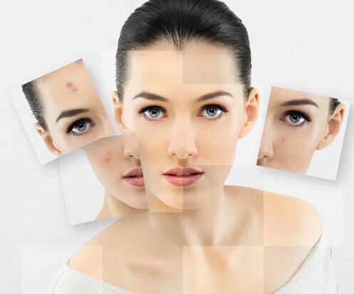 激光祛痘有好有坏 揭密你所不知的副作用