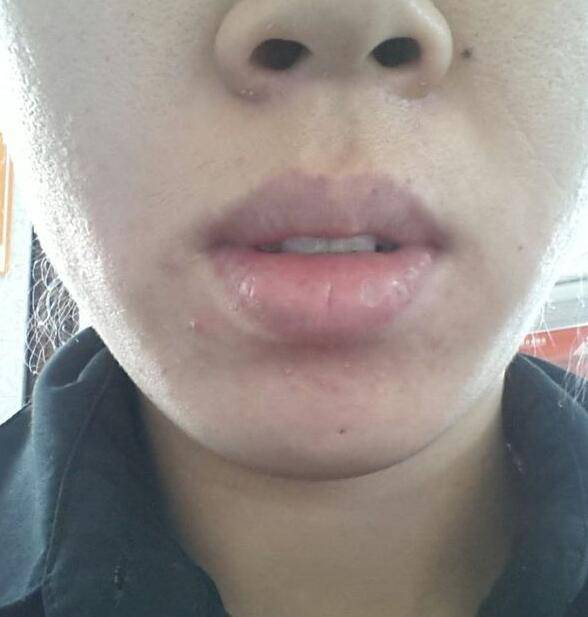 引起下巴痤疮的六大原因 千万不能用手挤