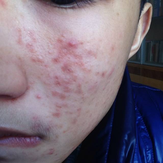 揭右脸长痘痘原因 三小妙招还你白嫩肌肤