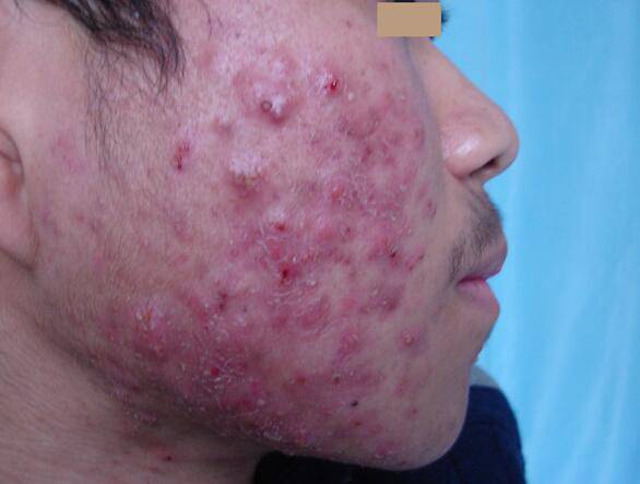 6个引起痤疮粉刺的原因 治疗痤疮粉刺偏方推荐