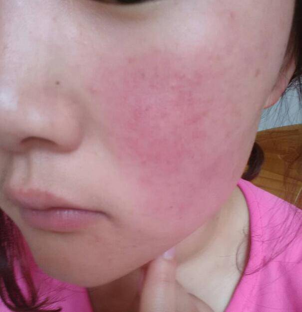 探究红血丝形成原因 四小妙招去除红血丝