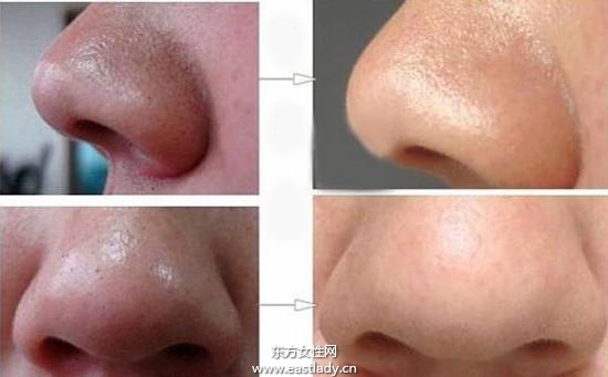 几个小诀窍教你怎么去除黑头粉刺最有效