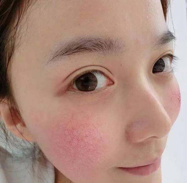 探究红血丝形成原因 四小妙招去除红血丝