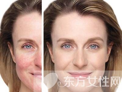 敏感肌肤用什么护肤品？