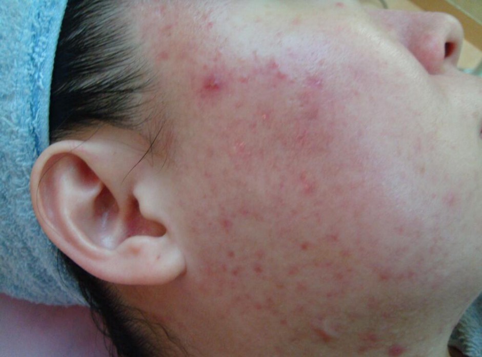 6个引起痤疮粉刺的原因 治疗痤疮粉刺偏方推荐