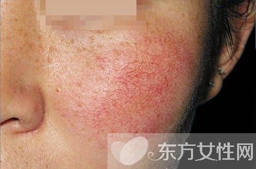 用什么可以去红血丝 这么做可以快速去除红血丝哦