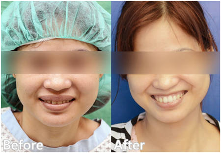 厚唇改薄 打造女明星完美微笑