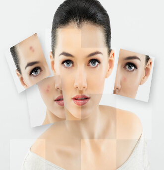 激光祛斑术前准备 激光祛斑注意事项