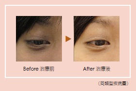 中药＋针灸去黑眼圈效果更好