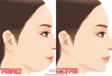 暴牙可以矫正吗 矫正后可以瘦脸吗