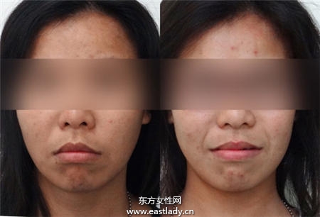 暴牙可以矫正吗 矫正后可以瘦脸吗