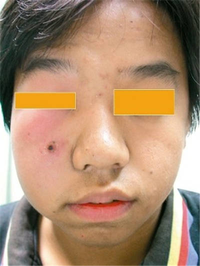 别把粉瘤当粉刺 两者到底有什么不同