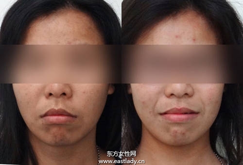 Angelababy 小S也做牙齿矫正 成功瘦小臉