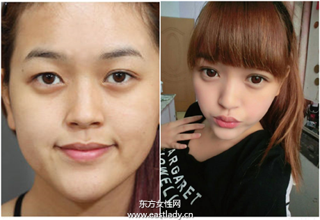 双眼皮该缝还是该割 要根据眼型来选择