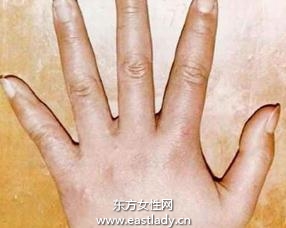 疥疮的最佳治疗方法