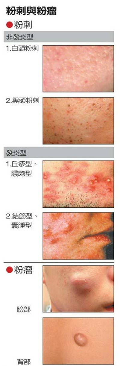 别把粉瘤当粉刺 两者到底有什么不同