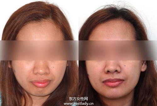 Angelababy 小S也做牙齿矫正 成功瘦小臉