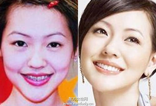 Angelababy 小S也做牙齿矫正 成功瘦小臉
