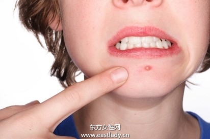 造成青春痘的原因以及治疗方法