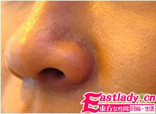 皮肤缺水表现 如何保湿