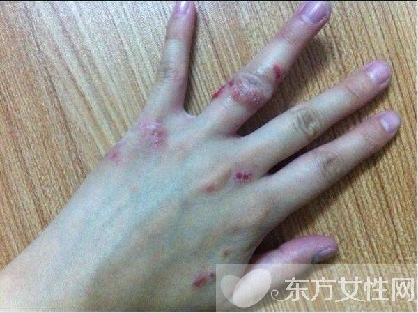 湿疹会传染吗 一些你不知道的治疗湿疹小偏方推荐