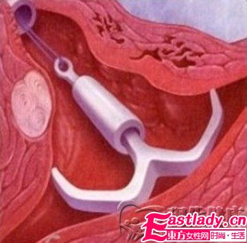 各种节育环的种类图片介绍