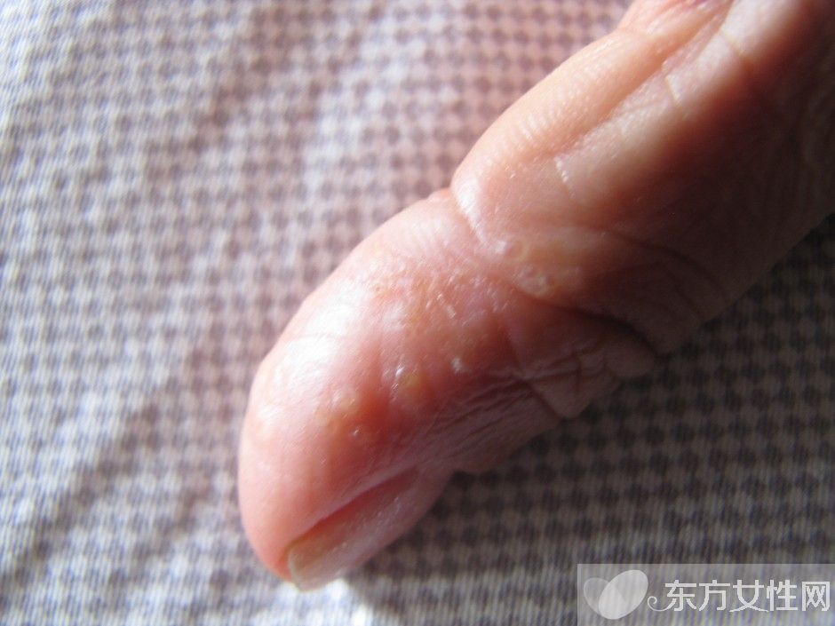 湿疹会传染吗 一些你不知道的治疗湿疹小偏方推荐