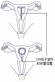 各种节育环的种类图片介绍
