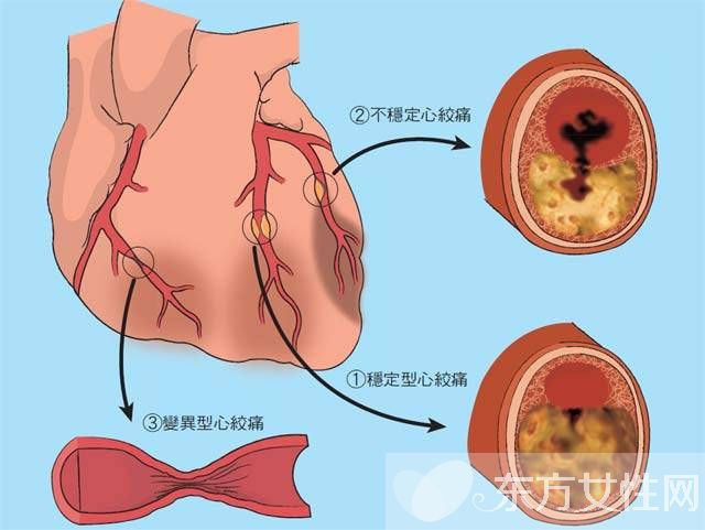 心绞痛的早期症状表现 出现这些状况一定要引起重视