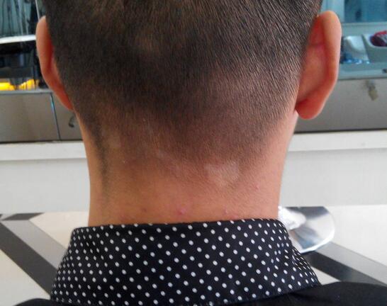 白色糠疹是什么 白色糠疹的病发原因是什么