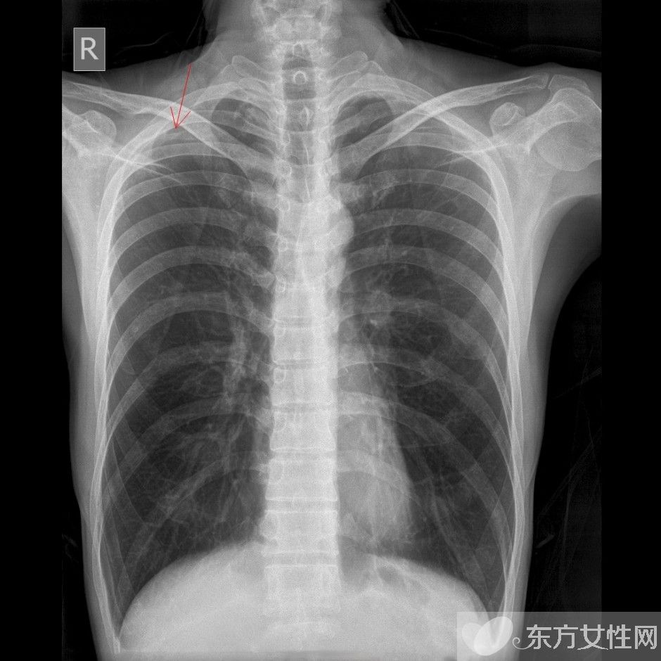 肺气肿会传染吗 治疗肺气肿的食疗偏方推荐