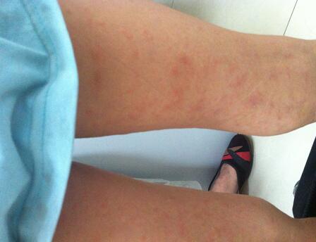 白色糠疹是什么 白色糠疹的病发原因是什么