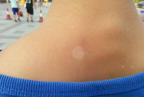 汗斑如何预防 荐5个有效治疗小妙招