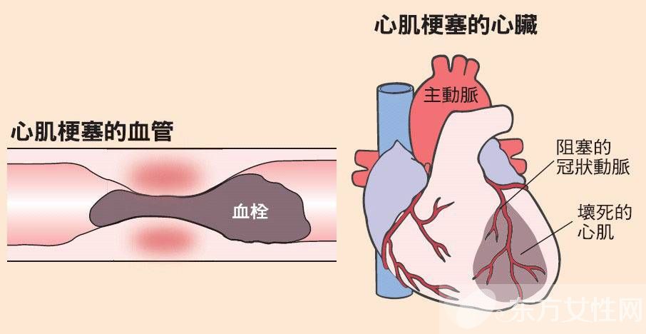 引发心肌梗塞的主要原因 这些早期症状一定要留意