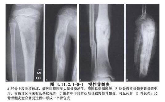 骨髓炎能治好吗 揭秘骨髓炎症状危害