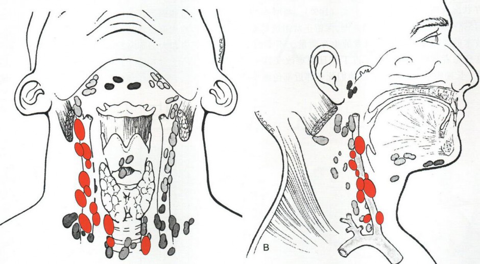 甲状腺癌术后饮食禁忌 解读甲状腺癌各类症状