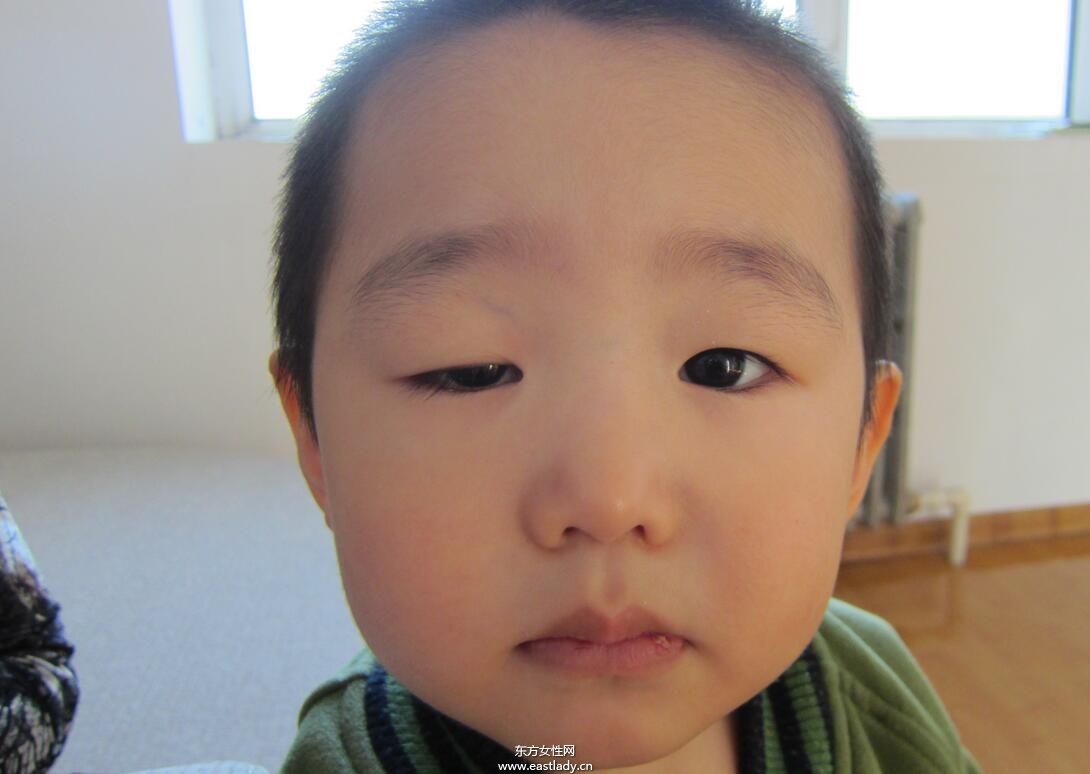 上眼皮突然下垂怎么办 这可能是疾病信号