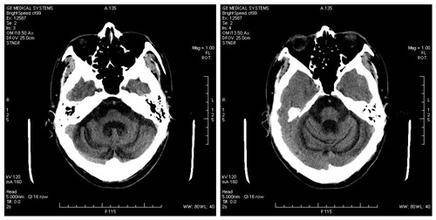 小脑萎缩的诱因及症状 小脑萎缩吃什么好