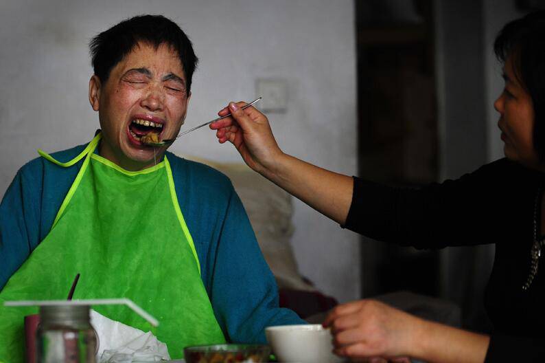 小脑萎缩的诱因及症状 小脑萎缩吃什么好