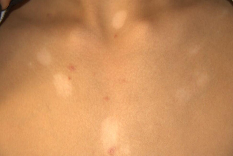 汗斑如何预防 荐5个有效治疗小妙招