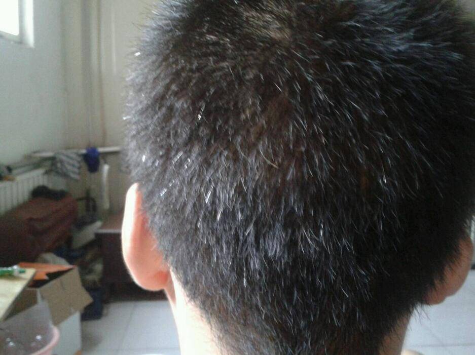 头发变白形成原因 看哪些你已中招