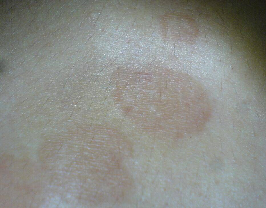 汗斑如何预防 荐5个有效治疗小妙招