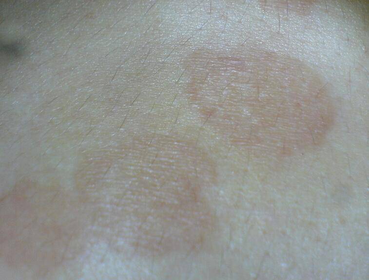 花斑癣如何预防 治疗花斑癣的小偏方介绍