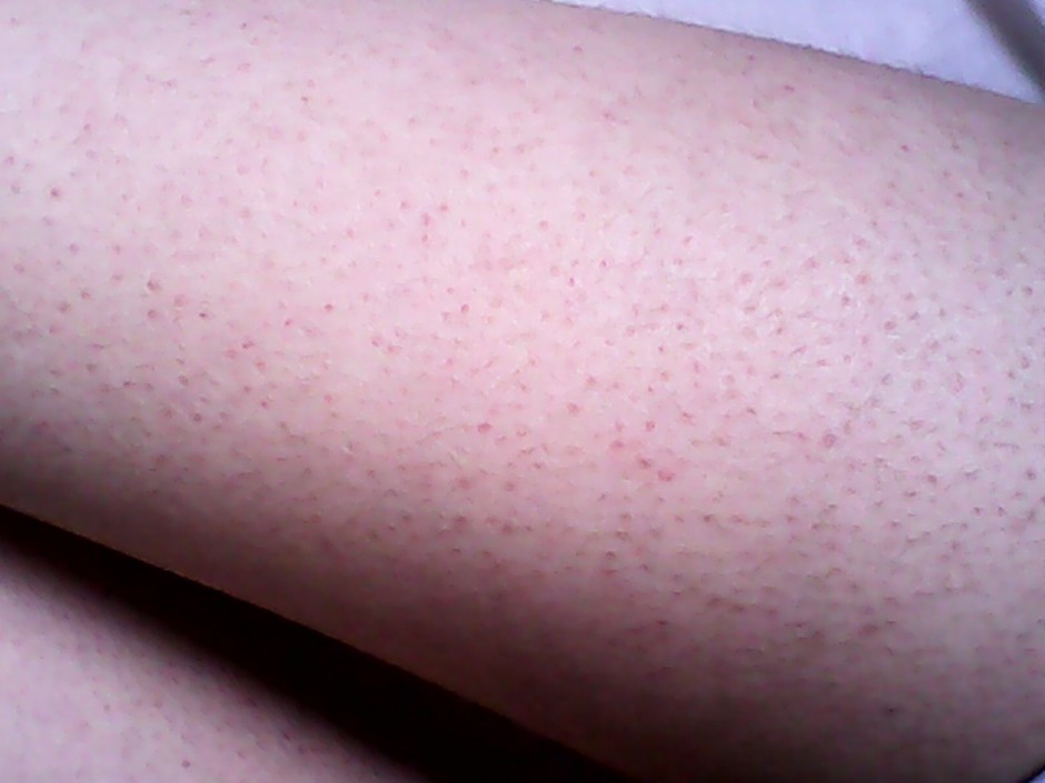 毛周角化是什么 揭你所不知的 鸡皮肤 治疗