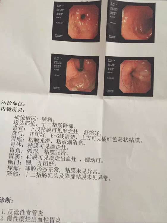 胃出血常见5大症状 胃出血最佳治疗方法