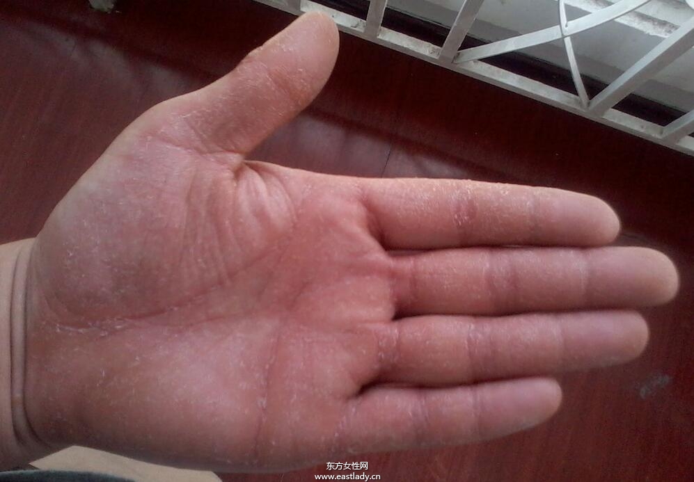 手上脱皮是怎么回事呢 轻松几招让你告别脱皮