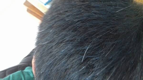 头发变白形成原因 看哪些你已中招