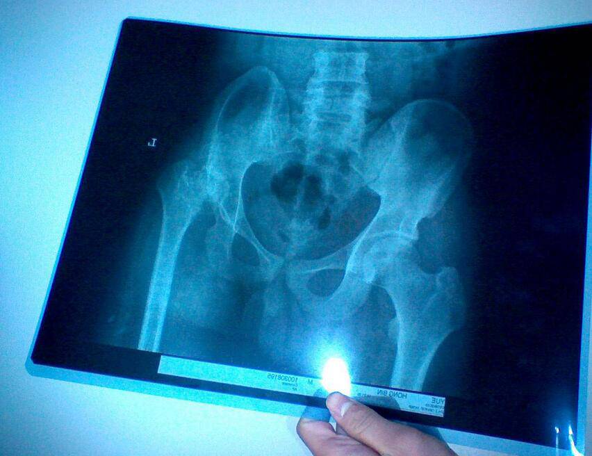 股骨头坏死四大常见症状 9款食疗助康复