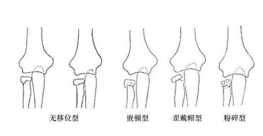 骨折愈合时间需要多久 愈合康复训练