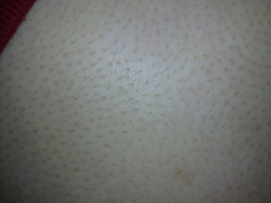 毛周角化是什么 揭你所不知的 鸡皮肤 治疗